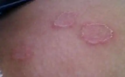 女性慢性淋病症状 女性慢性淋病吃什么药 - 红丝带网