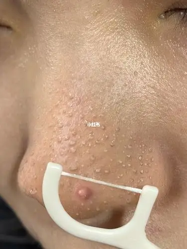 什么痘痘黑头粉刺闭口都可以在我脸上凑一桌打麻将了.