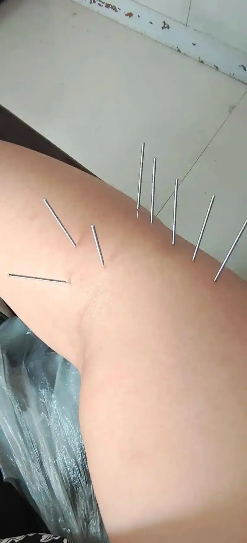 针灸实拍图 有时候,就是想大哭一场,因为心里憋屈.有时侯, - 抖音