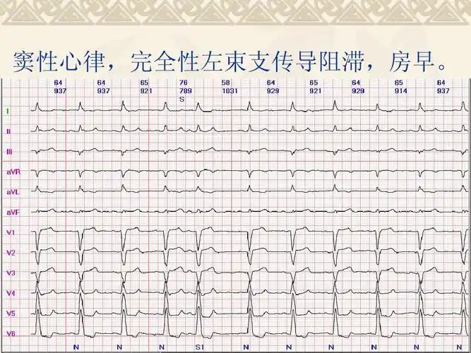 窦性心律,完全性左束支传导阻滞,房早.