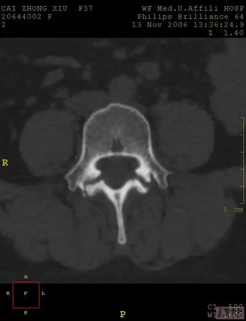 分享典型病例椎弓崩裂患者影像图片
