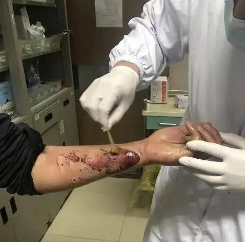 危险中年男子胳膊被爆竹炸伤这些急救知识要牢记