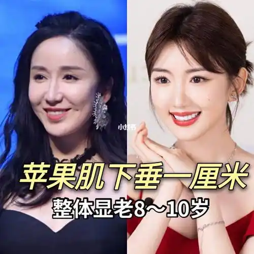 苹果肌下垂提升的好方法