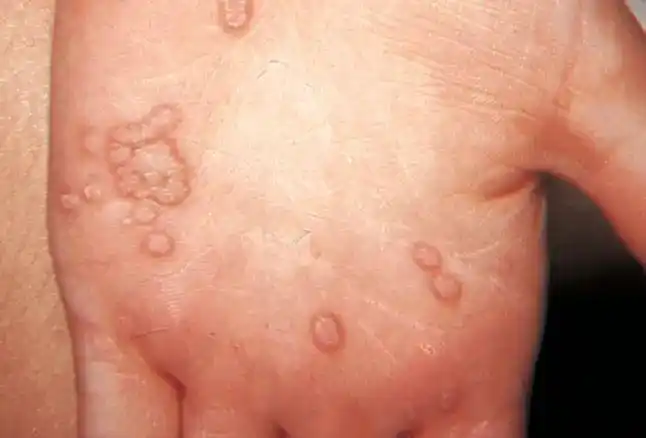 身上的小疙瘩,可能和hpv感染有关|感染|皮肤|生殖器|-健康界