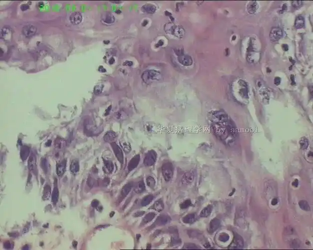 也不能吃一些干燥的食物尿道两边痒还有小疙瘩2  未婚女性尿道口痒