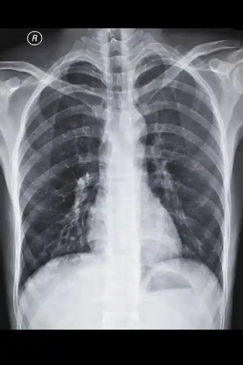 肺部x射线图像