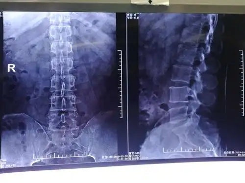 腰椎间孔镜治疗椎间盘突出1例