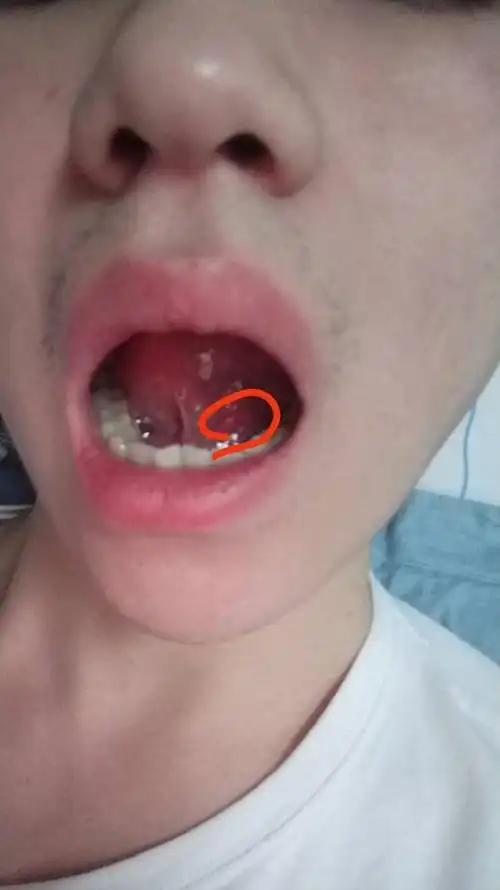 我舌头下面长了一个东西我也不知道是什么,我想问一下是不是口腔溃疡