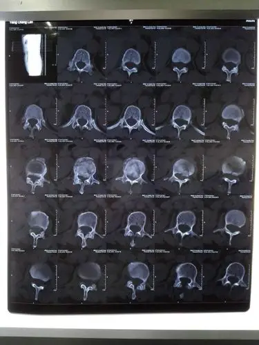 l1骨折 - 好大夫在线