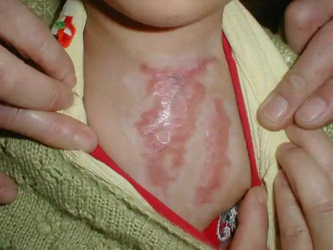 宝宝烫伤留下了瘢痕,怎么办? - 好大夫在线