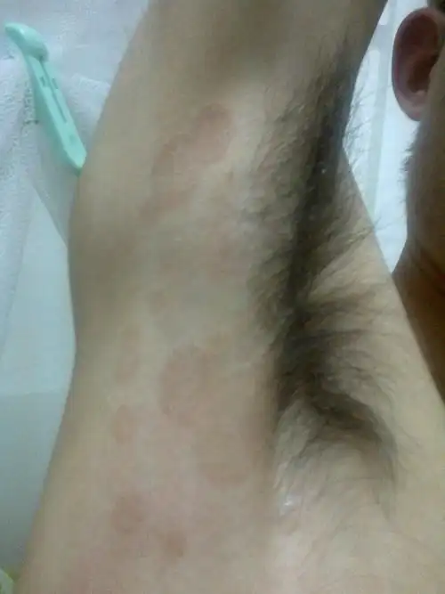 请问这是什么花斑癣吗_百度知道