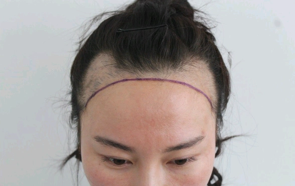 发际线种植案例