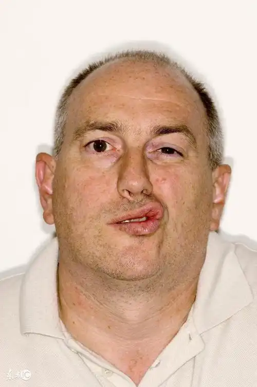 面瘫前会出现些什么症状(面瘫发作时的11个症状有哪些)2