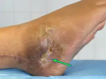 得了骨髓炎怎么检查出来