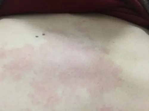 胸口上有一大块红色的斑,不痛不痒的,18岁的时候就有了,一直没注意