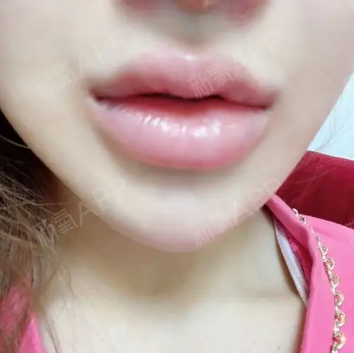 丰唇好不好_效果图_加油美少女玻尿酸丰唇术后第0天_新氧美容整形