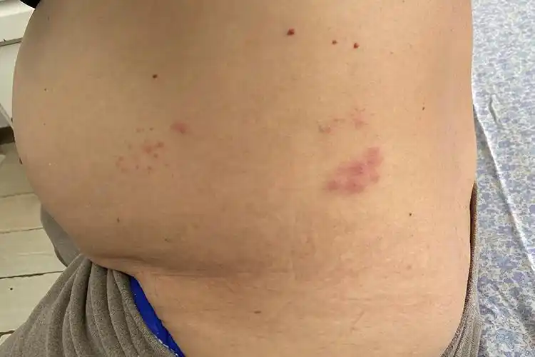 女性患者带状疱疹早期症状图