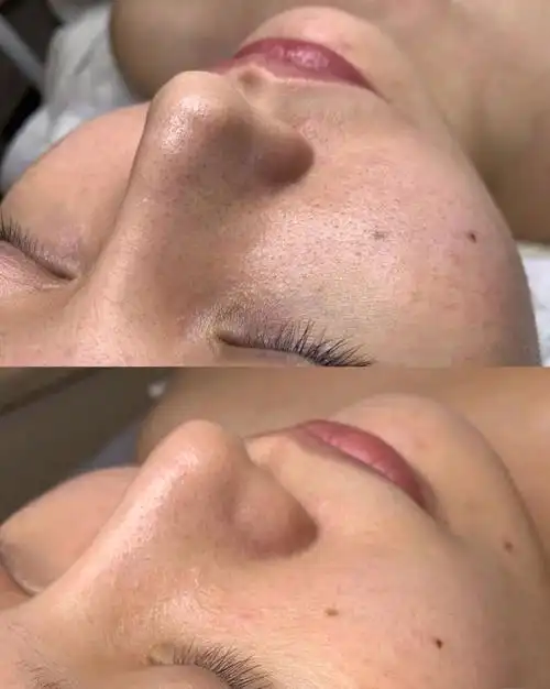 韩式小气泡前后对比图