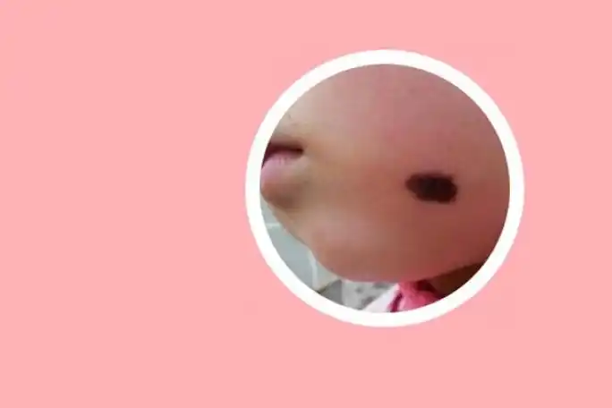 良性黑色素痣图片大全早期症状