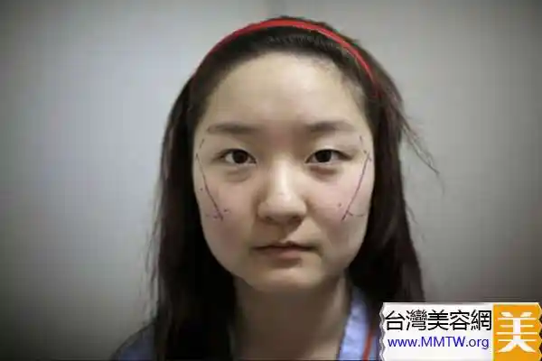 韩国「人造美女」大赛 5位选手整形手术过程