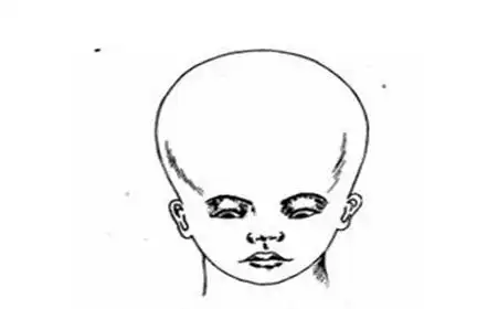 脑积水都是先天性的吗