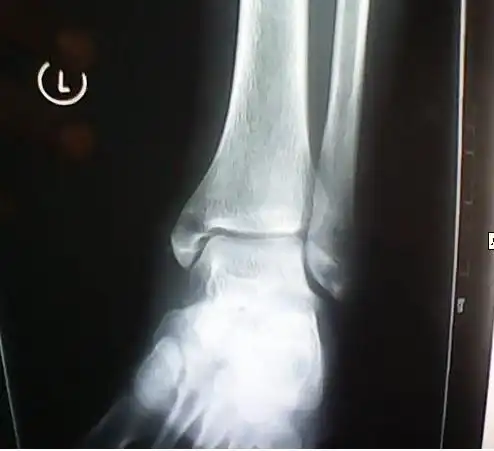 内踝骨折不做手术能痊愈吗?