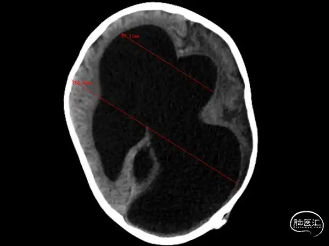广州医科大学附属第五医院 病例分享:婴幼儿脑积水病例分享