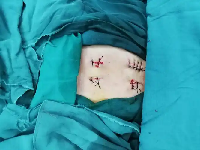 微创手术三甲医院要求的.腰1椎体骨折经皮椎弓根钉内固定术