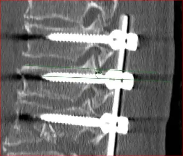 骨科技巧 | 徒手胸椎椎弓根螺钉技术