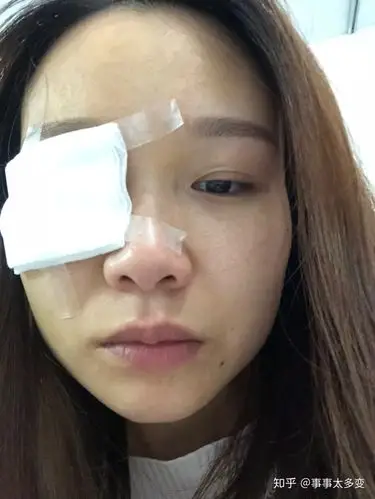 这是手术完第一天,刚拆完纱布,护士把我的睫毛都剪掉了
