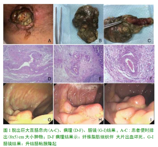 经肛门排出巨大结肠息肉1例论文