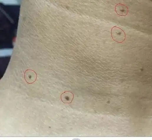 脖子上长小瘊子怎么办