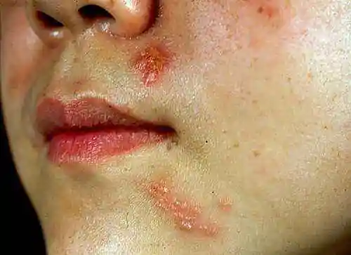 疱疹感染图片 (6)
