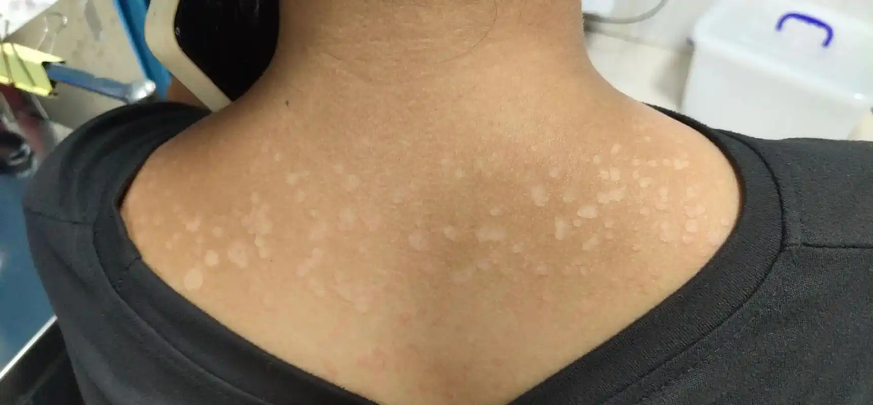 皮肤科医生的日常——花斑癣大合集#皮肤科医生 - 抖音