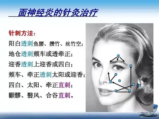 针灸治疗面瘫