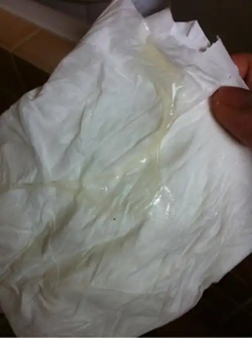 正常的白带形态的图片