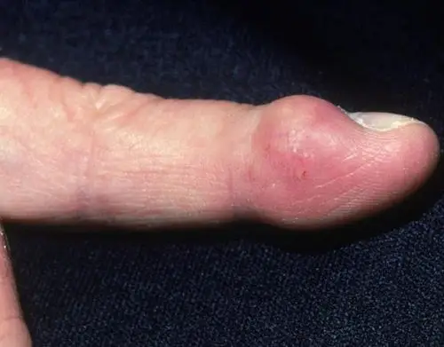 囊肿肿物肿瘤?别傻傻分不清楚!