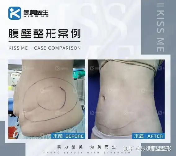 产后腹部拉皮收紧腹直肌有多重要