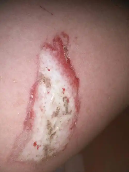 我在工地上上班受伤,左大腿根部属于三度烫伤.马上两个月没有