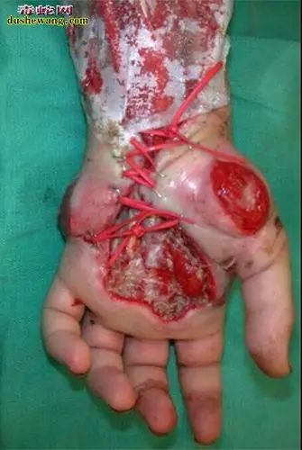 治疗不当导致的结果我公司治疗的毒蛇咬伤患者,自己