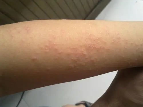 孩子胳膊上起的小疙瘩,有二个星期了,还是下不去,听孩子说有点痒痒.