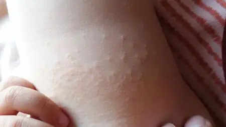 2岁3个月宝宝腿上张(疑似)热痱子,有两星期了,请大家看看这是什么