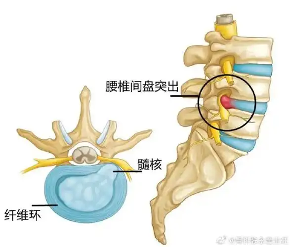 腰椎间盘突出##中医