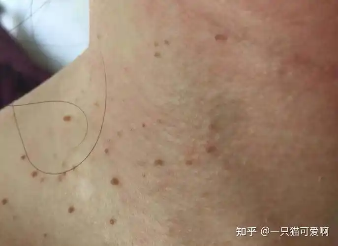 高危行为后,勿把hpv当皮肤病,3种情况或是身体在求救