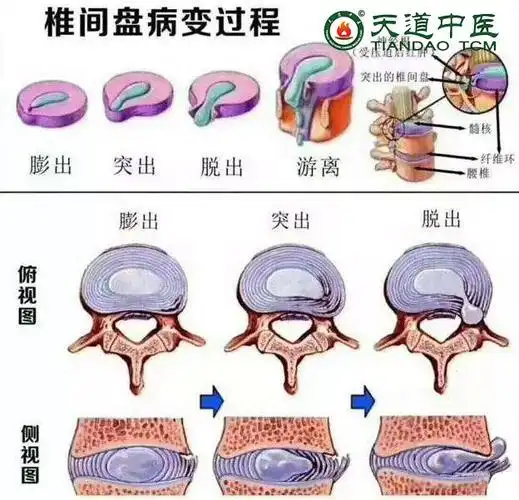 颈椎间盘突出与膨出的区别
