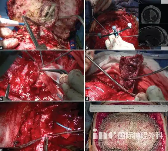 头部开颅手术全过程图