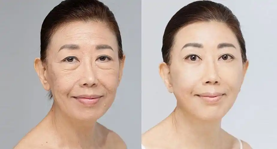 30岁想做超声刀抗衰老美容效果怎么样有哪些功效?