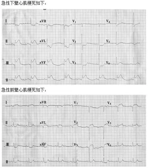 实践技能考试15种心电图速记