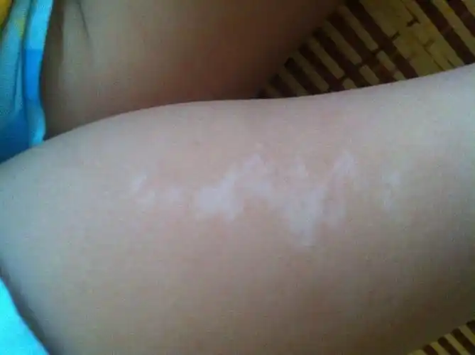 这到底是什么?我好担心宝宝脚上长的是什么,请专家给我解答一下,谢谢