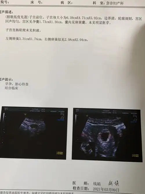 45天男孩胎囊图片